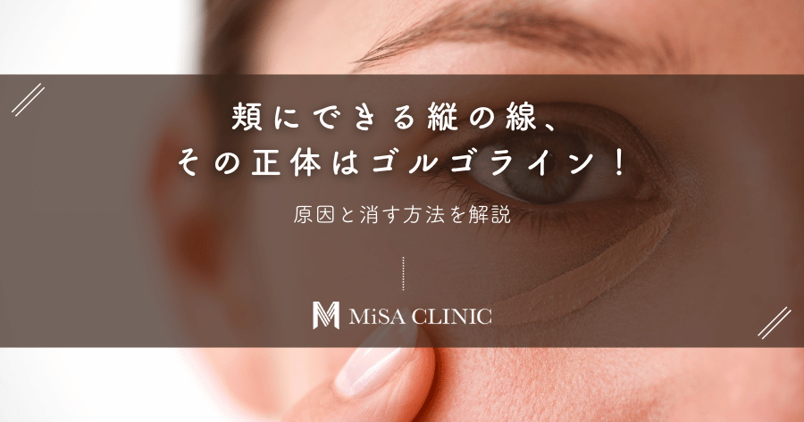 頬にできる縦の線、その正体はゴルゴライン!原因と消す方法を解説