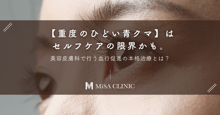 【重度のひどい青クマ】はセルフケアの限界かも。美容皮膚科で行う血行促進の本格治療とは？