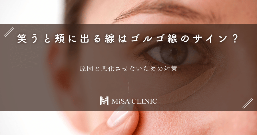 笑うと頬に出る線はゴルゴ線のサイン?原因と悪化させないための対策