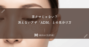 茶クマじゃない？消えないアザ「ADM（後天性真皮メラノサイトーシス）」との見分け方