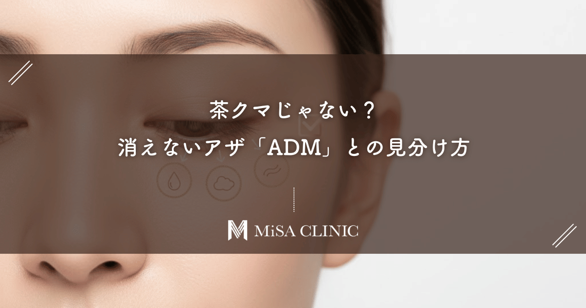 茶クマじゃない?消えないアザ「ADM(後天性真皮メラノサイトーシス)」との見分け方