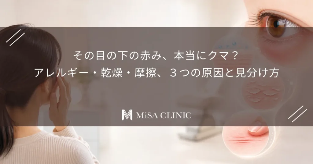 その目の下の赤み、本当にクマ？アレルギー・乾燥・摩擦、３つの原因と見分け方