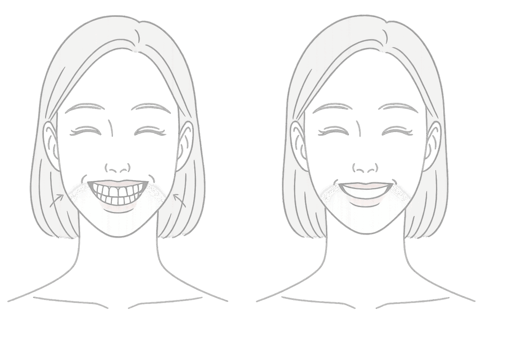 ガミースマイルを改善し自然な笑顔を実現するボトックスイラスト