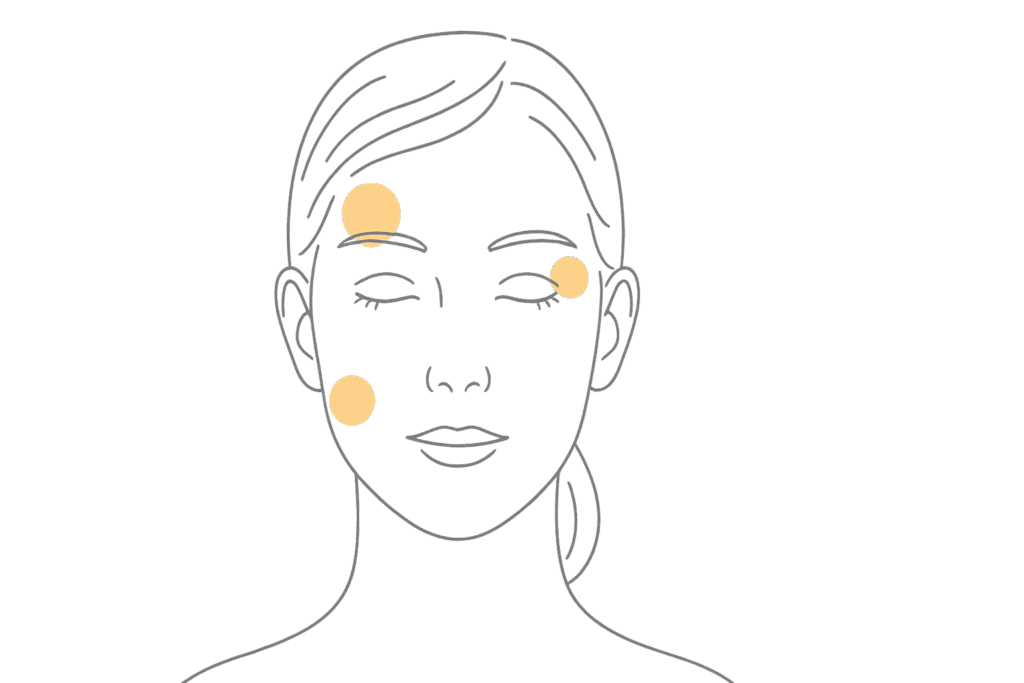 ボトックス注射で痛みを感じやすい部位のイラスト