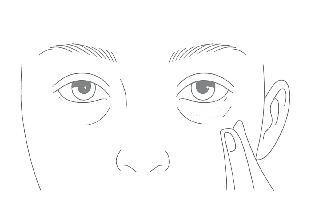 クマ取りは“完全ゼロ”ではない:軽微な腫れ・内出血のイメージ