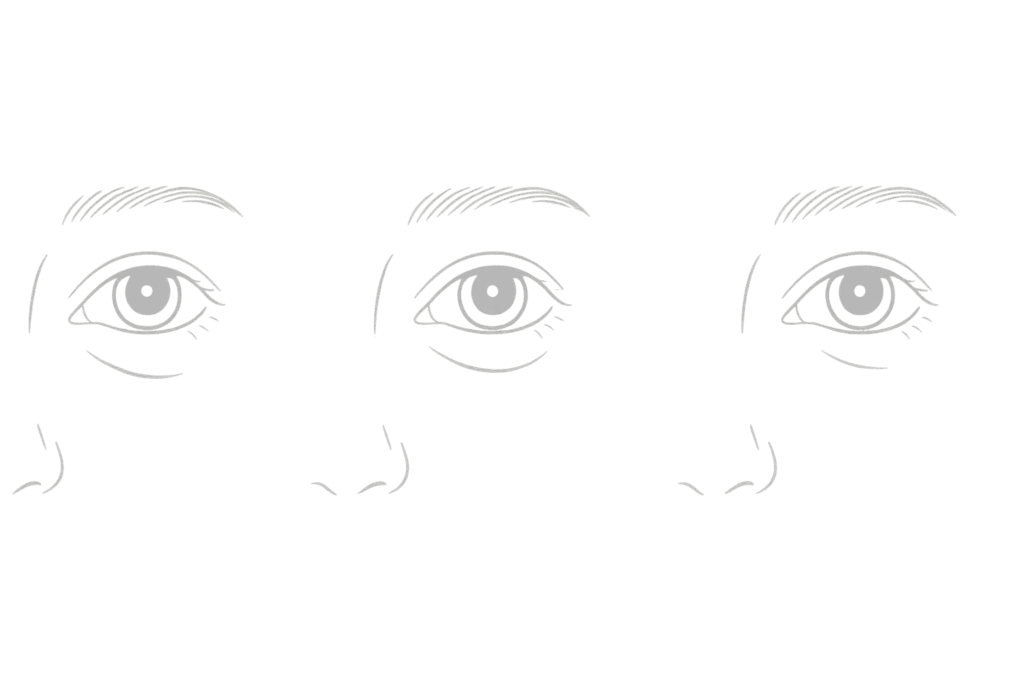 クマ取り後の左右差タイプ早見図(くぼみ・膨らみ・ライン差)