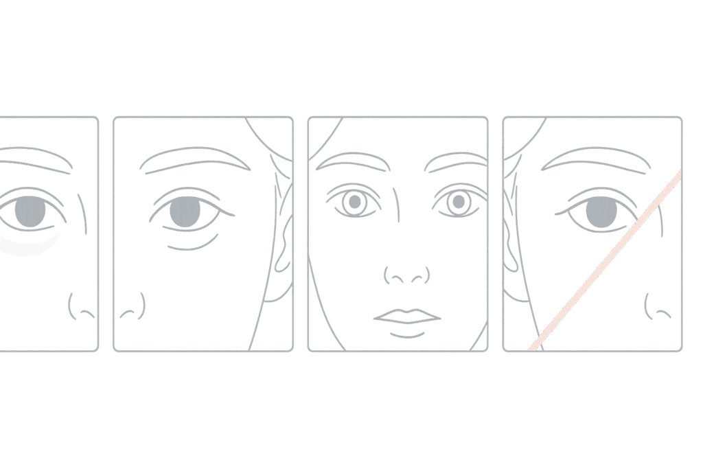 切らないクマ取り治療で起こり得る失敗例のイメージ