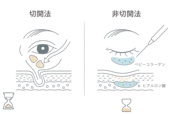 切開法と非切開法の違い（経結膜脱脂・表ハムラ vs 注入治療）