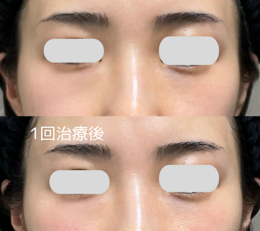 ヒアルロン酸(ジュビダームビスタ®ボリューマXC)