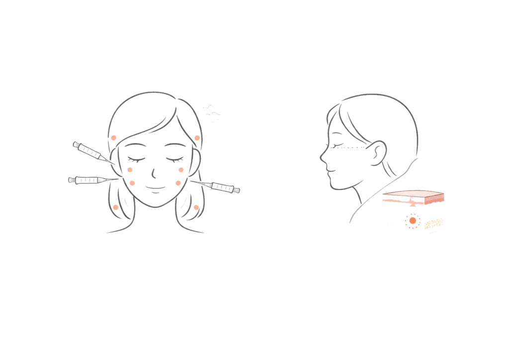 40代たるみのコンビネーション治療例（注入＋表情筋・熱治療の組み合わせ）