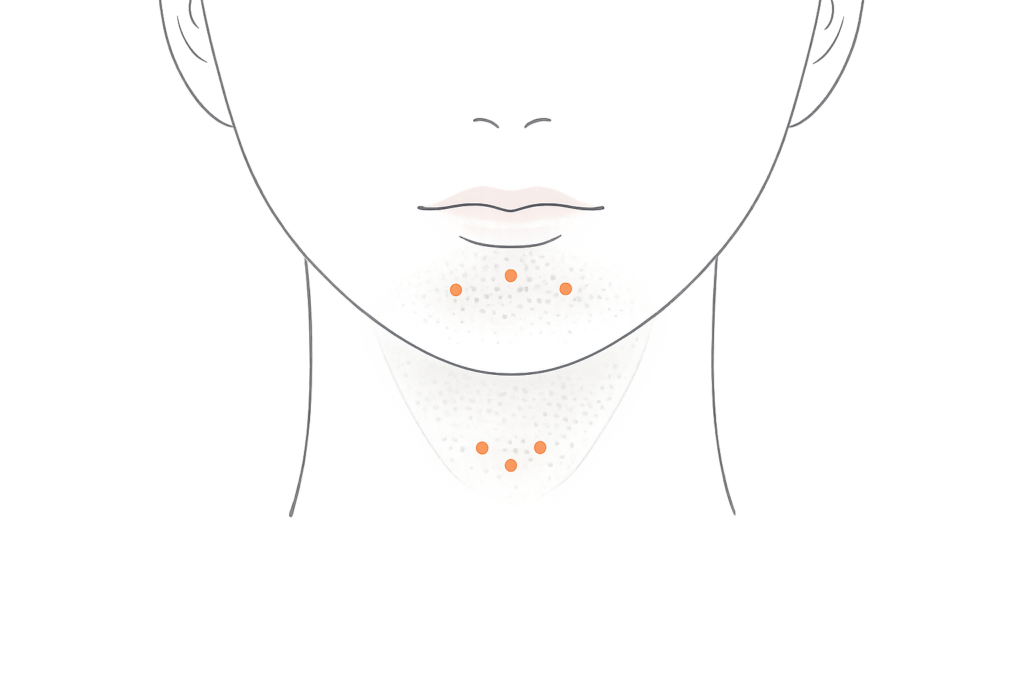 顎ボトックスの注入部位（オトガイ筋と梅干しジワの関係）