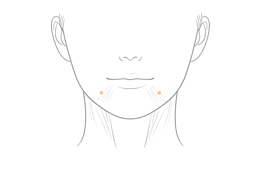 口角ボトックスの注入部位（口角下制筋へのアプローチ）