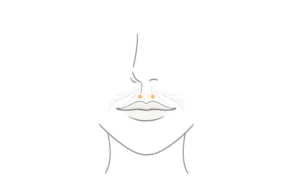 人中ボトックスの注入部位（上唇を引き上げる筋への調整）