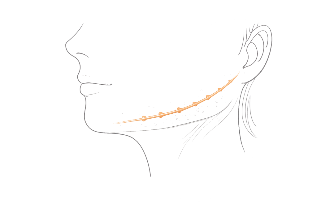 糸リフトとは（皮下に糸を挿入してたるみを支える仕組み）