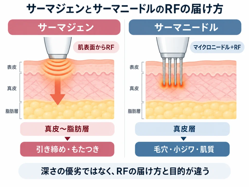 サーマジェンとサーマニードルのRFの届け方