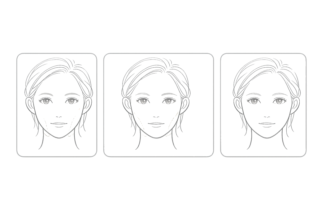 ハイフ後の赤み・腫れ・むくみの一般的な経過イメージ