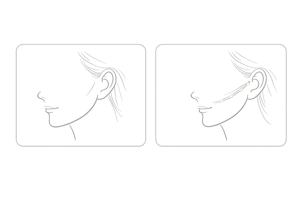 ジェンバー糸のメリット（リフトアップ＋ボリューム補正の考え方）