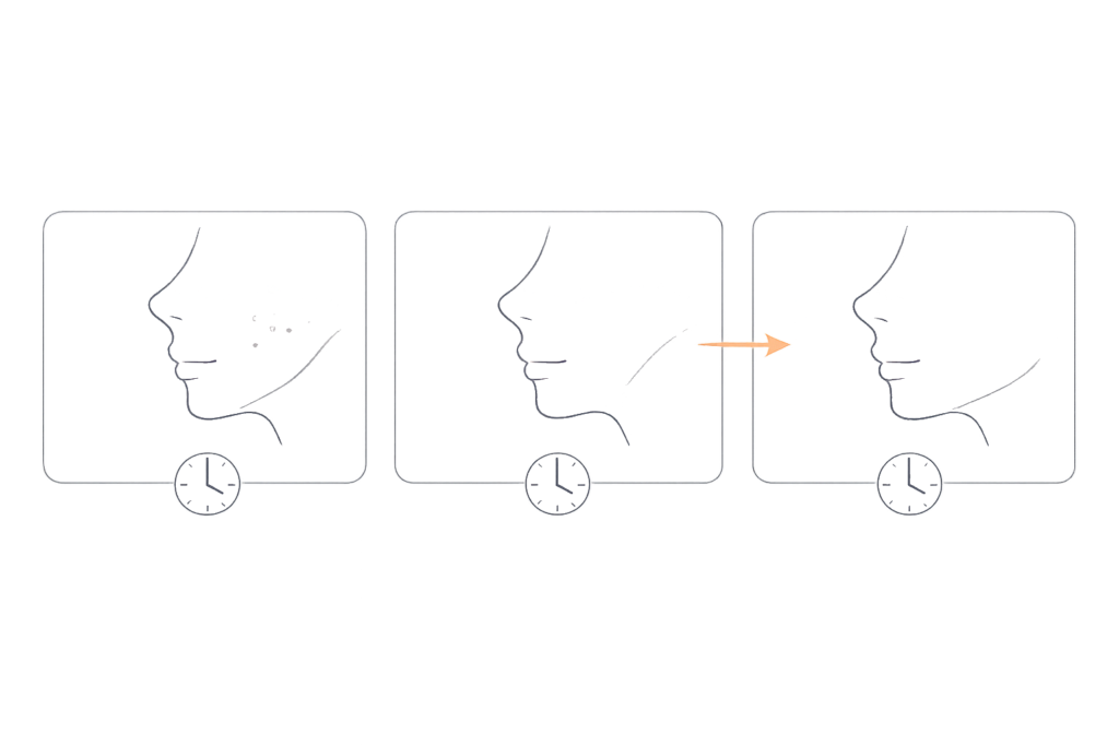 糸リフトの主なダウンタイム（腫れ・内出血・ひきつれの起こりやすい部位）