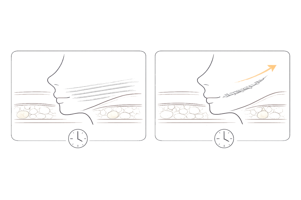 糸の種類で必要本数が変わる（細い糸多数 vs 太いコグ糸少数の比較）