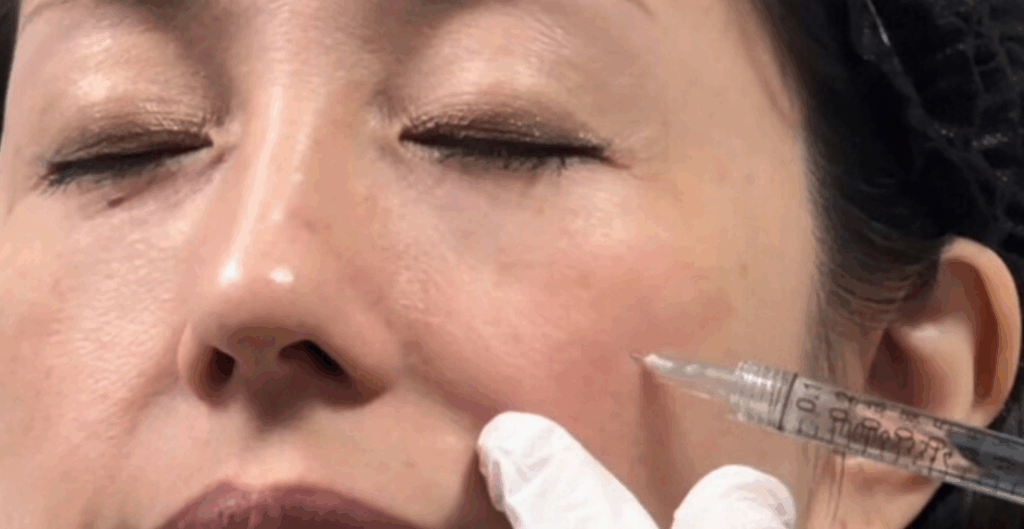 ヒアルロン酸注射