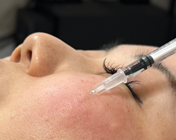 リジュラン注射