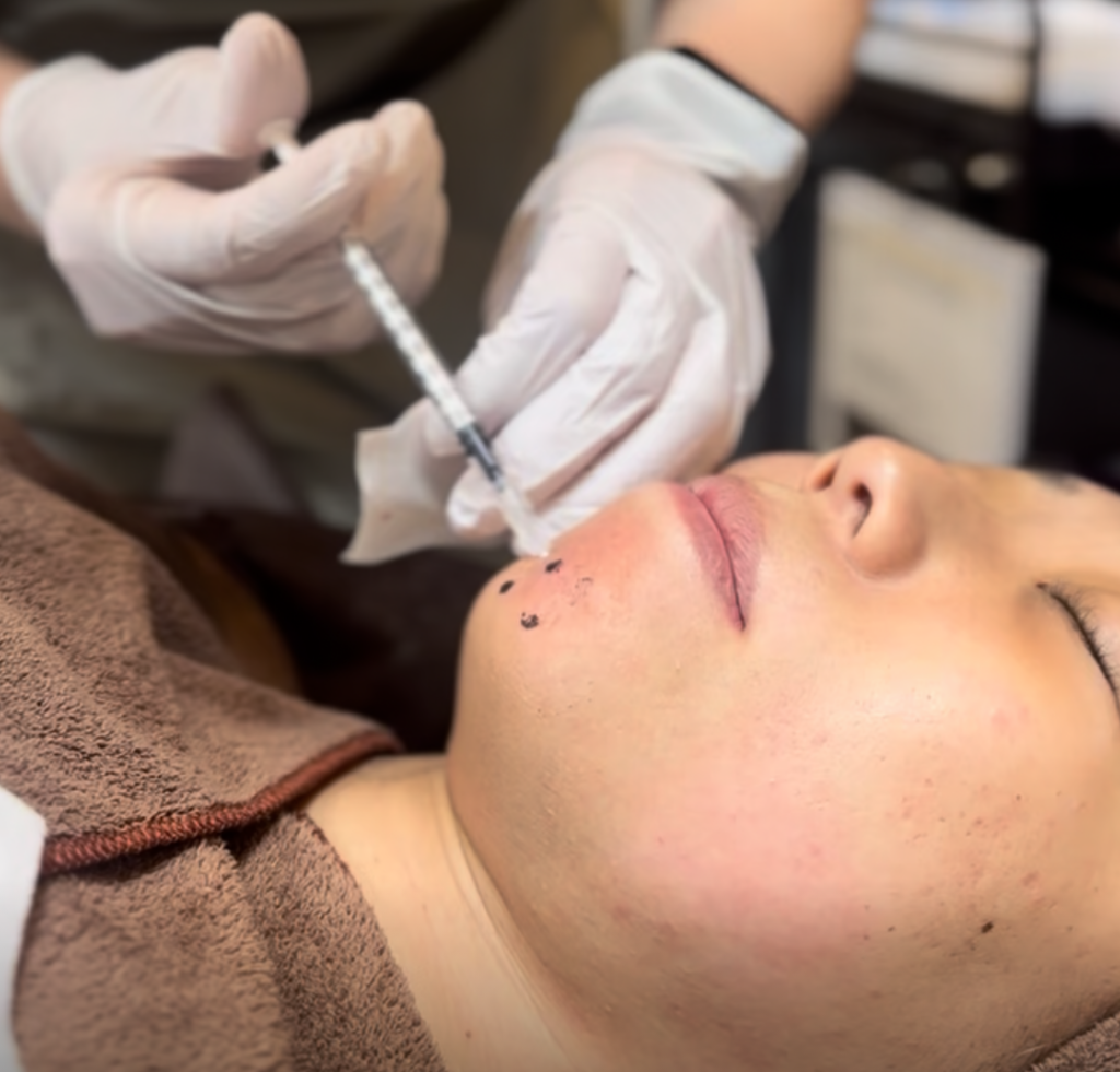 ボトックス注射