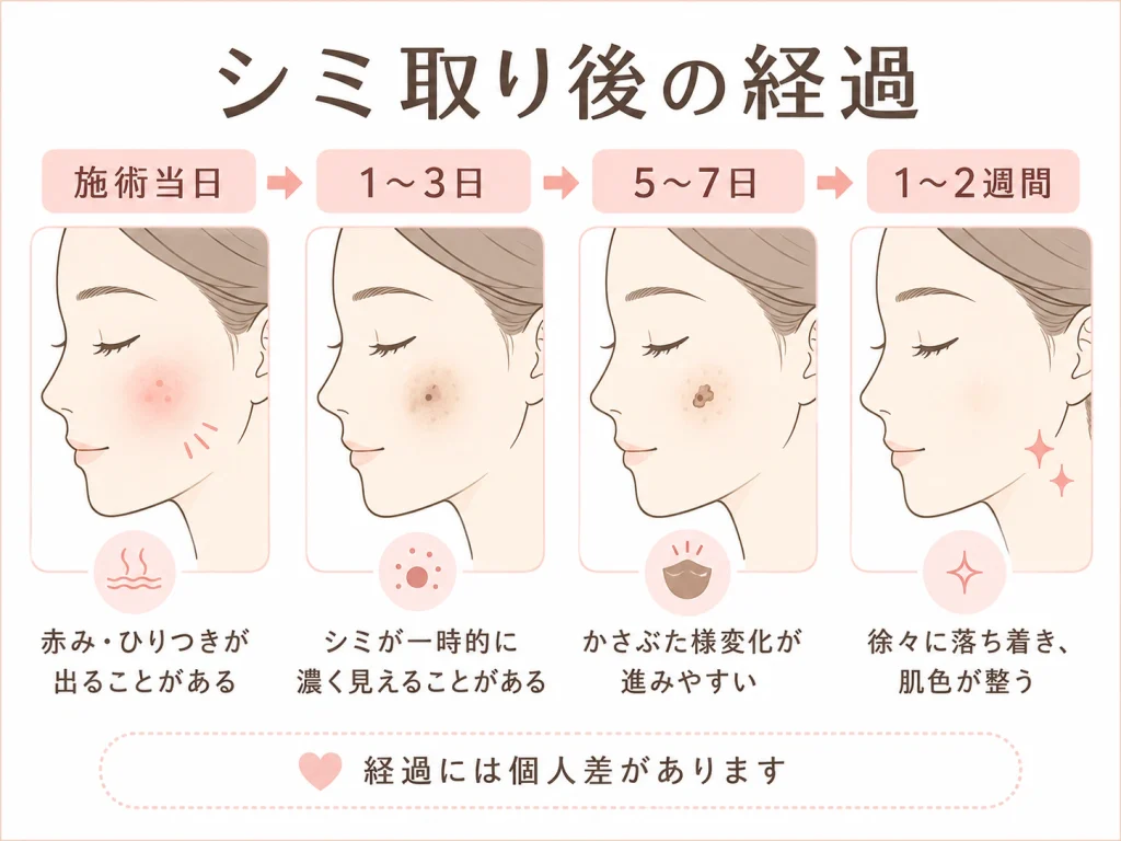 図解2_シミ取り後の経過タイムライン