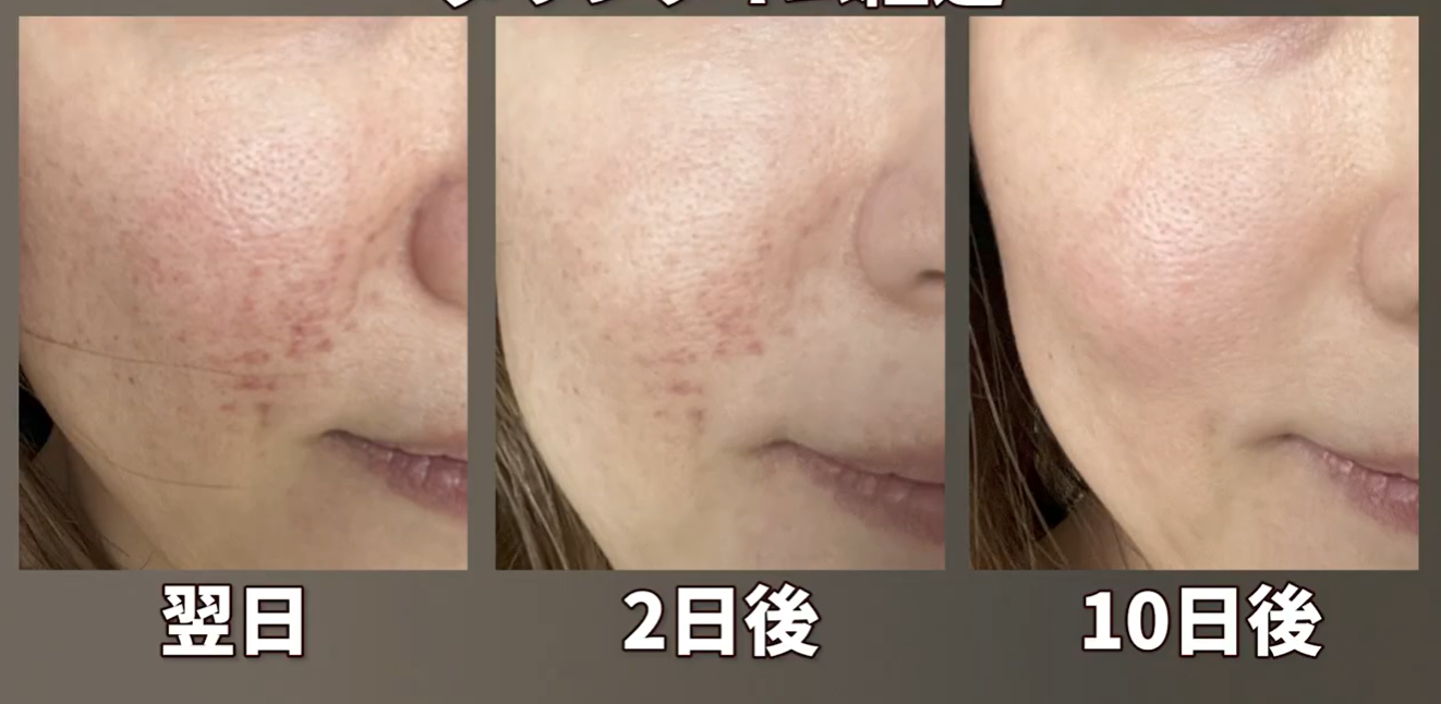 早い物勝ち‼️一日一台のみ！美肌マシン 針がない水光注射 EMS 水光注射】痛み、ダウンタイム、効果、全て医師自ら体験の上解説します