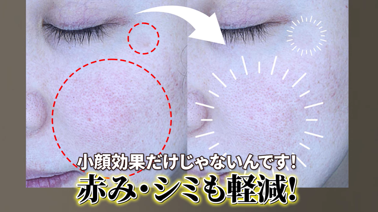 【訳あり】サーママジック　業務用美容高周波 高周波RFの実力検証！たるみ治療に加えて赤みも改善！ | 港区の切ら