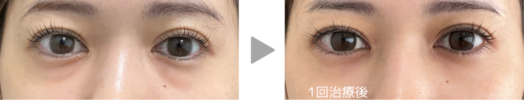 ベビーコラーゲン症例写真