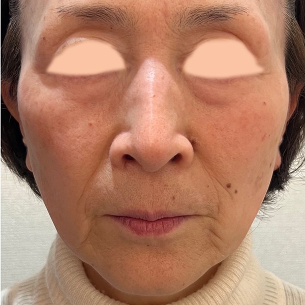 スネコス症例写真