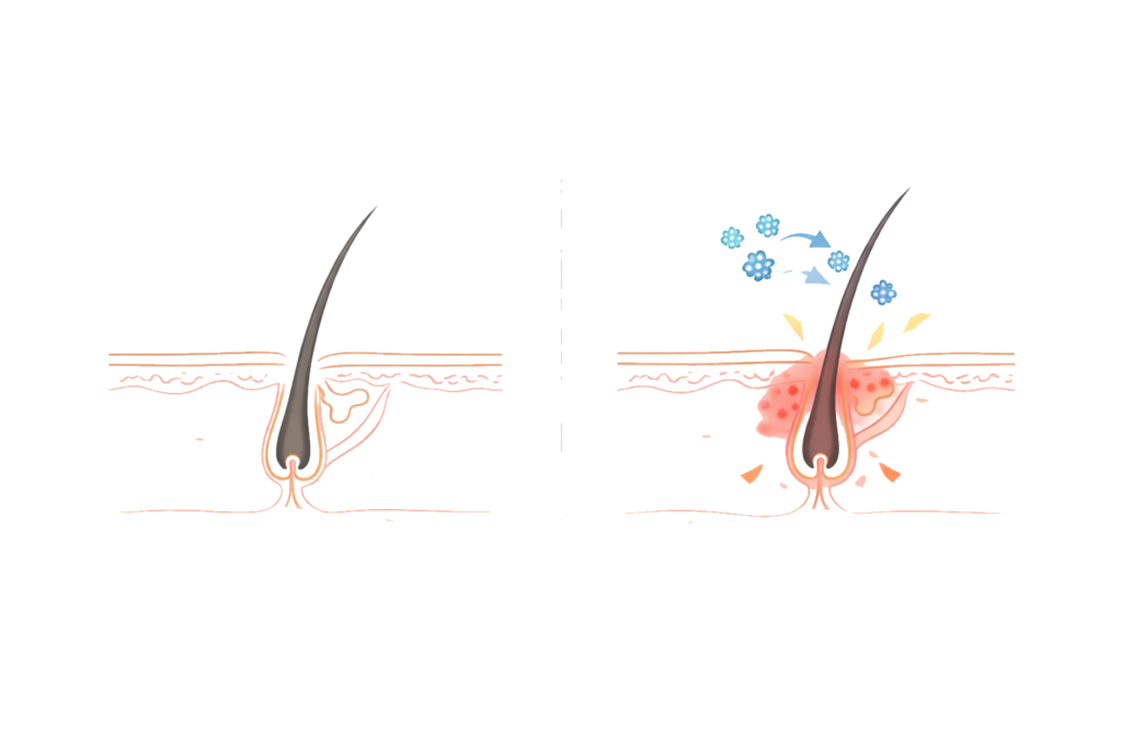 VIO脱毛時の痛み軽減対策(冷却・麻酔)のイメージ