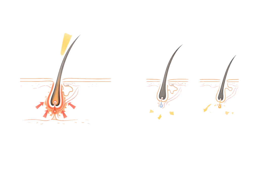 成長期の毛にレーザーが反応する仕組みと効果の違い