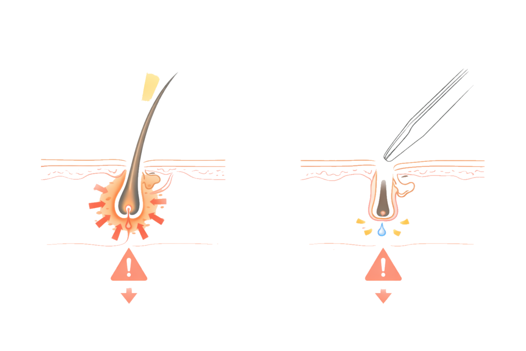 脱毛期間中に避けるべき行動（日焼け・毛抜き）と影響図