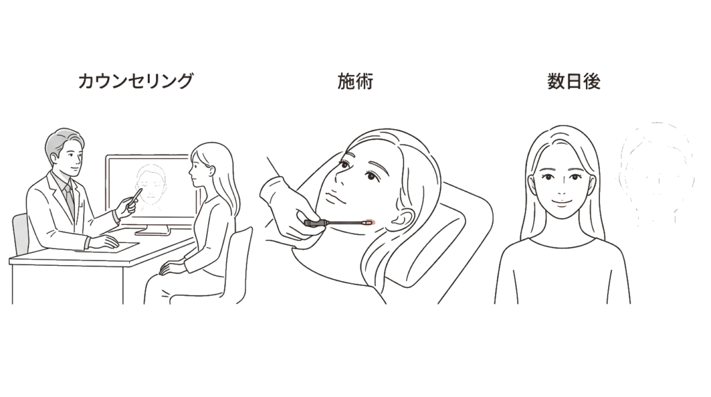 アッティバ施術の流れとダウンタイム経過イラスト