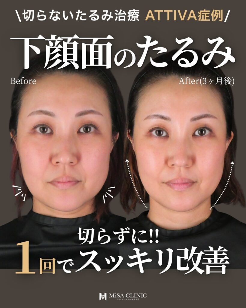 たるみ治療のアッティバの効果