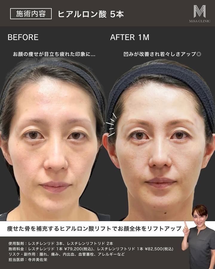 ヒアルロン酸でのリフトアップ症例