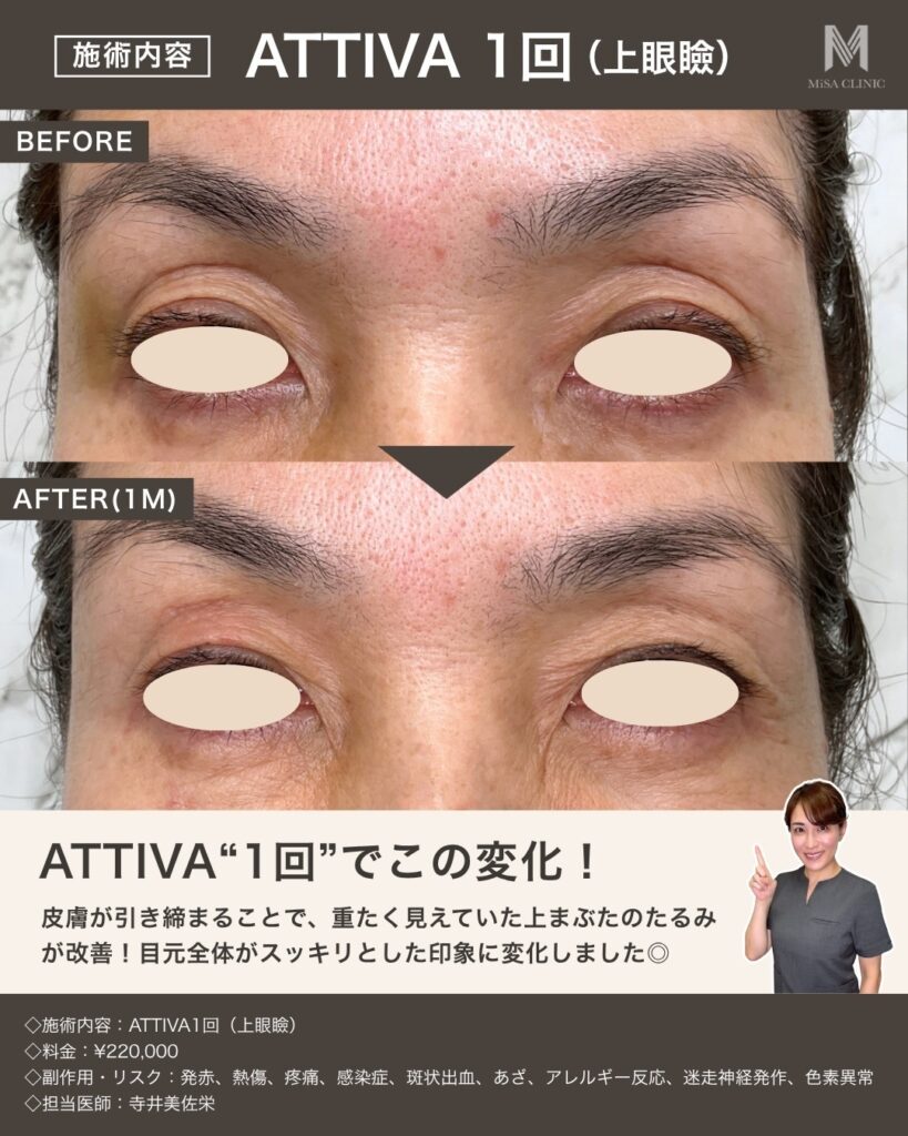 アッティバの症例