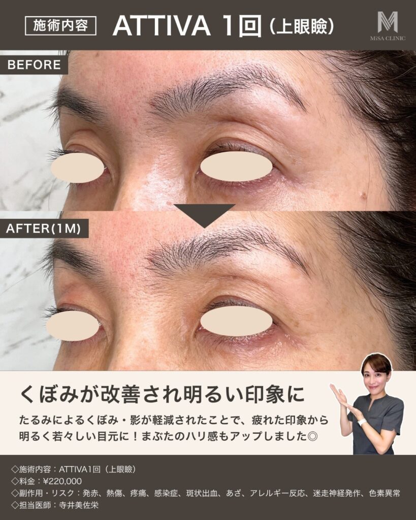 アッティバの症例