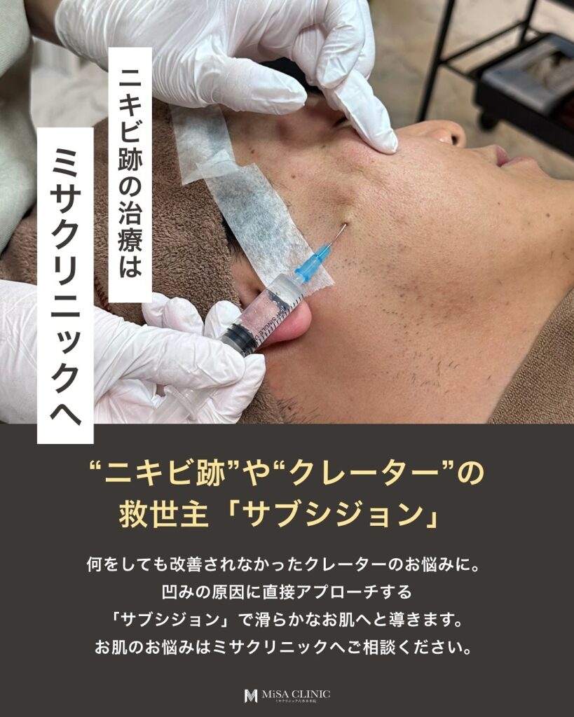 ニキビ跡、クレーターを治療するサブシジョンについて