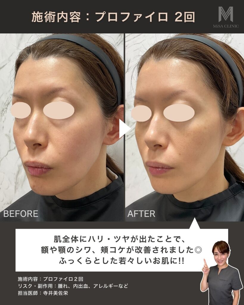 プロファイロを2回受けたときのビフォーアフター
