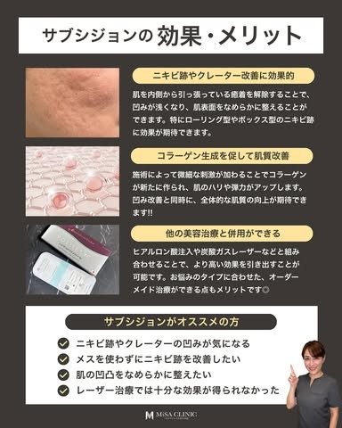 サブシジョンの効果、メリット