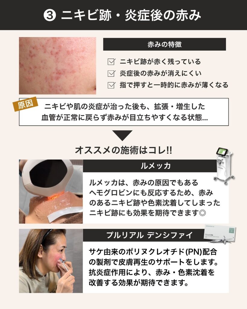 ニキビ跡や炎症後の赤みにはルメッカやプルリアルデンシファイ